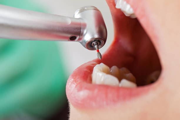 Best Emergency Wisdom Teeth Removal in Sandia Knolls, NM